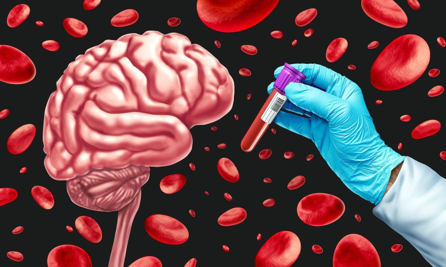 آزمایش خون جدید برای آلزایمر
